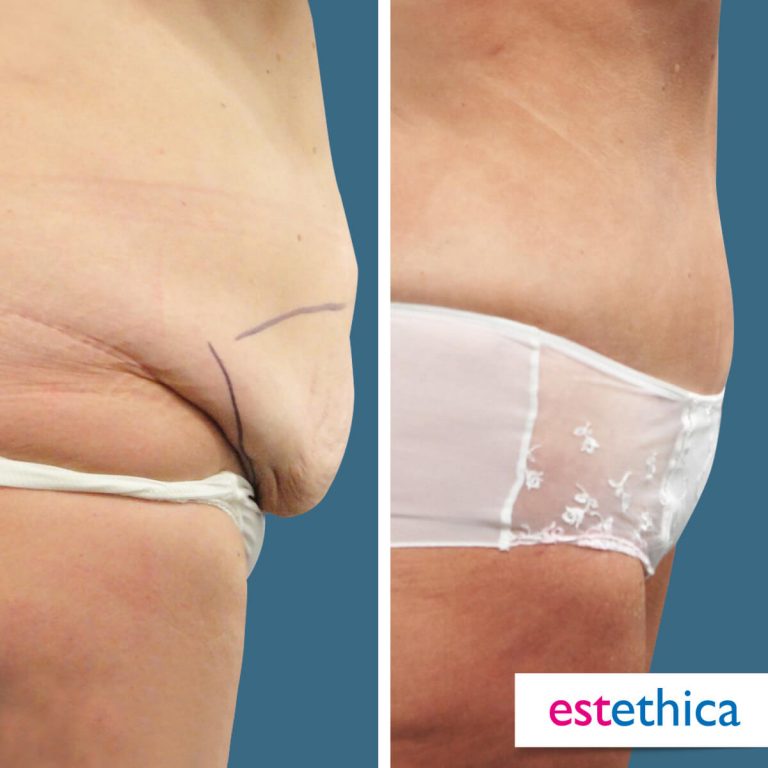 Abdominoplasty_OnceSonra_1