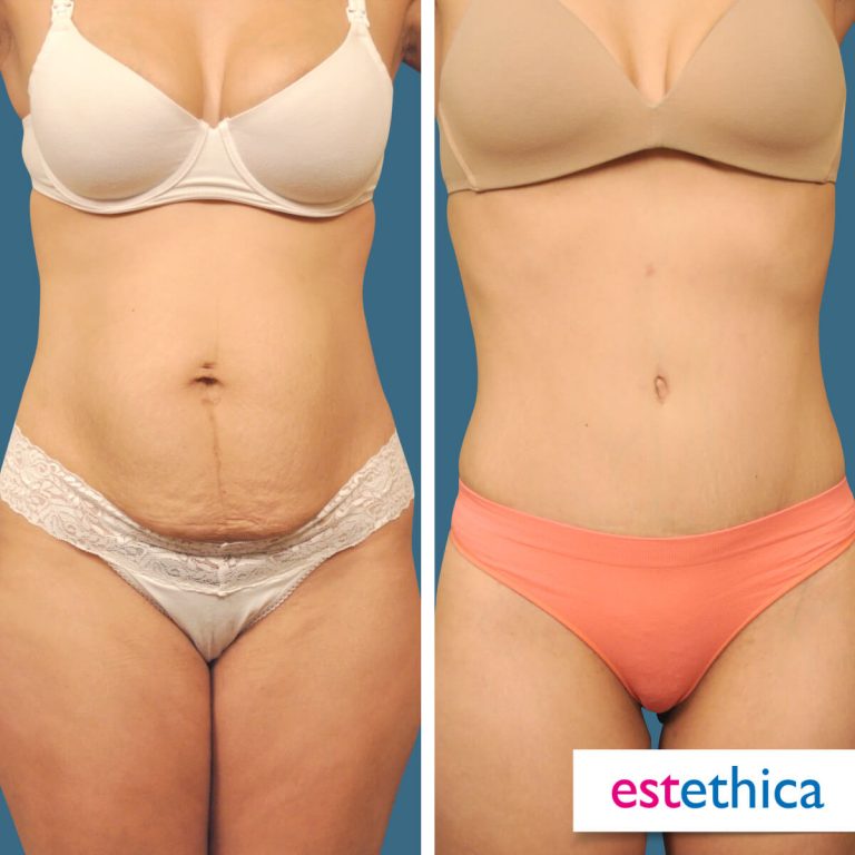 Abdominoplasty_OnceSonra_2