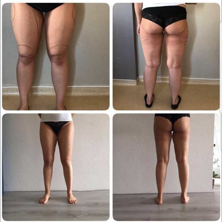BEFORE-AFTER-001
