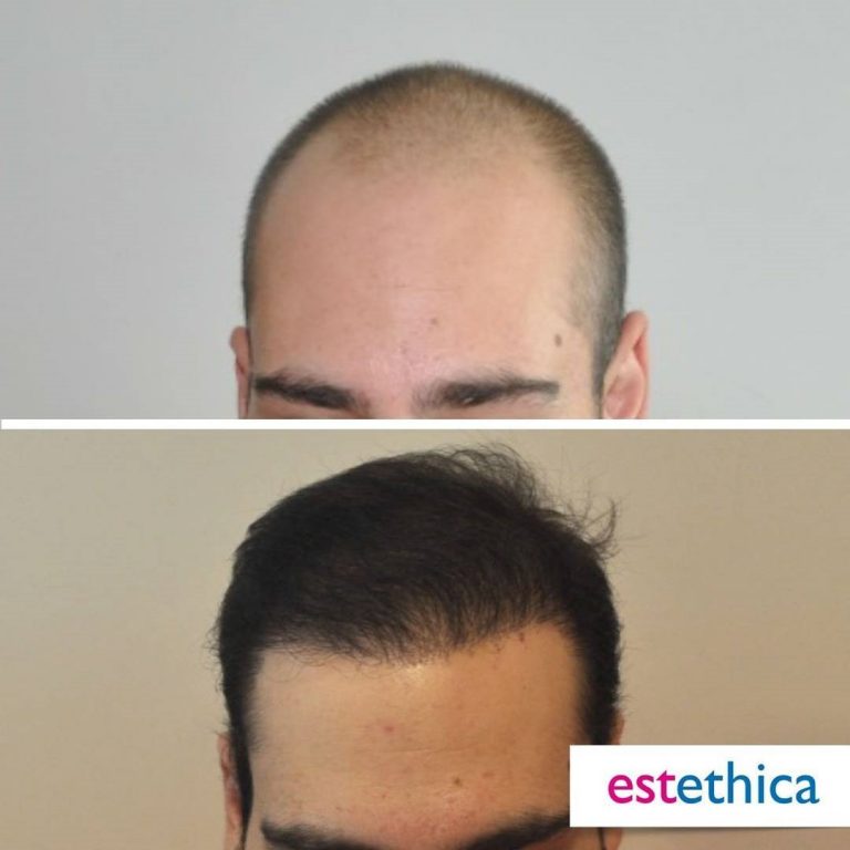 Before After 17