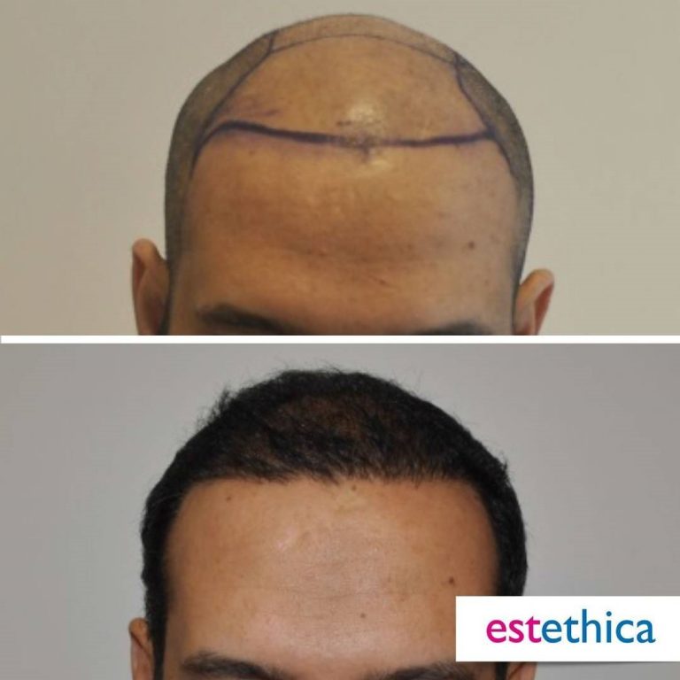 Before After 18