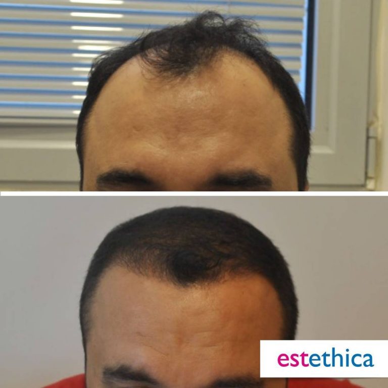 Before After 19