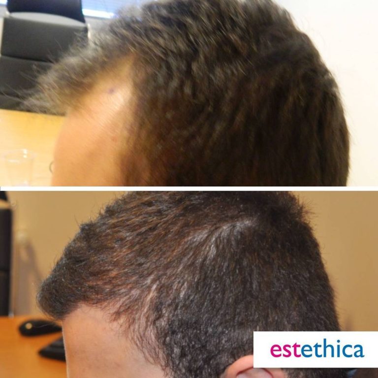 Before After 20