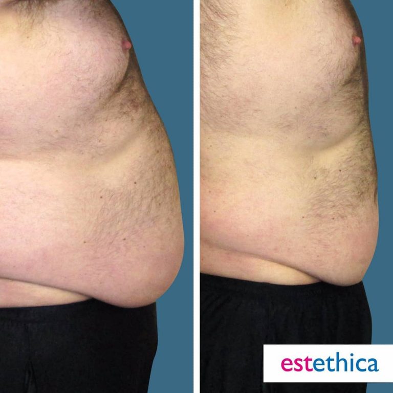 Before after lipo 15