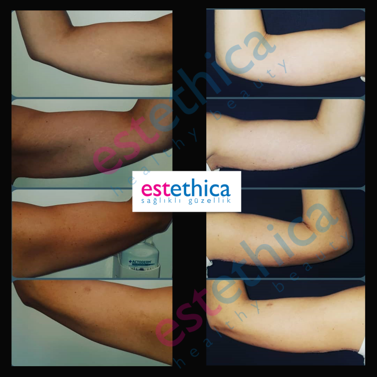 Brachioplasty-2