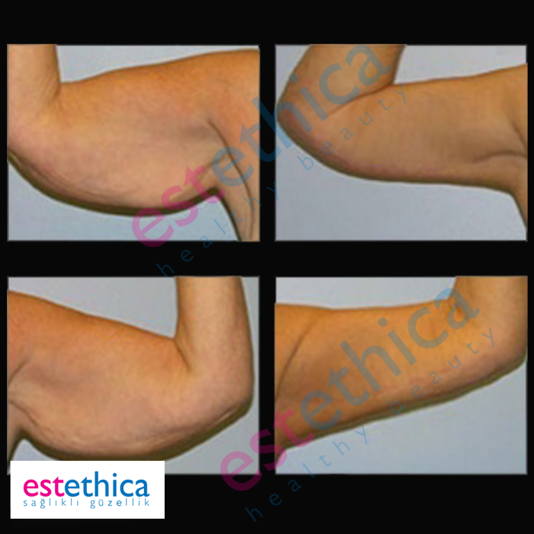 Brachioplasty-3