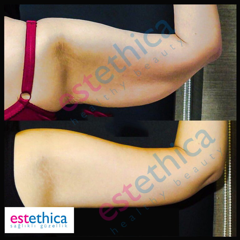 Brachioplasty-4