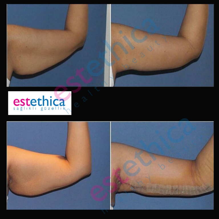 Brachioplasty-5