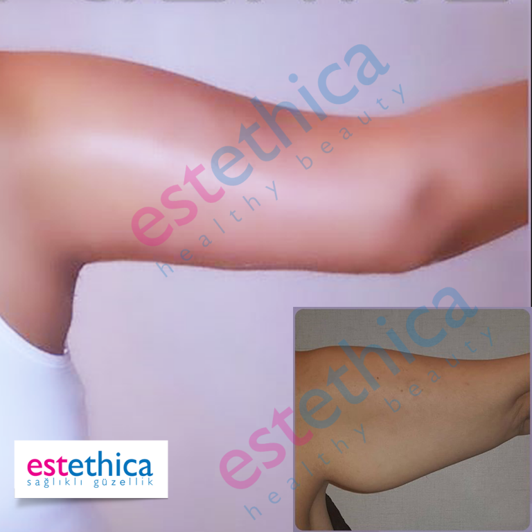 Brachioplasty