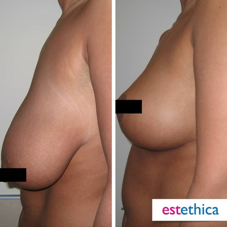 Breast Lift 3