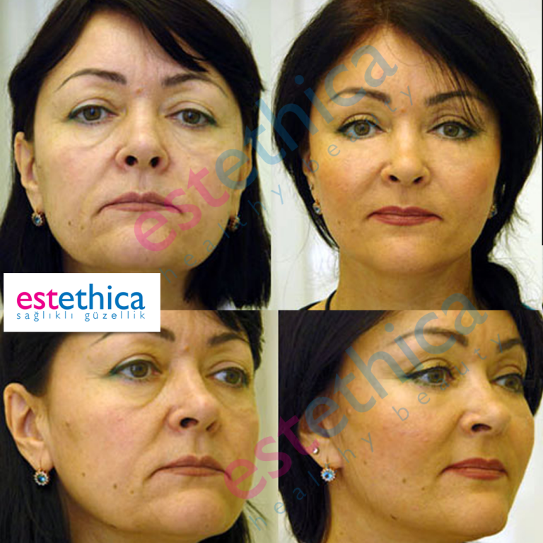 Face-Lift-W-1