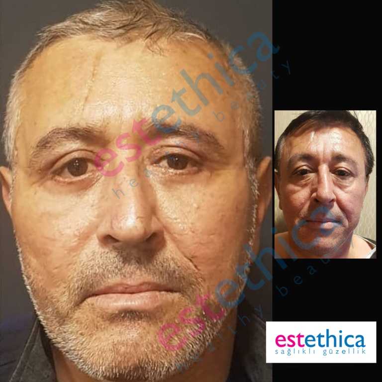 Face+Blepharo-M