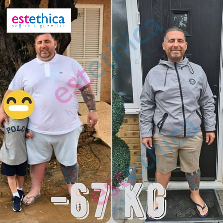 Gastric-Sleeve--1--M