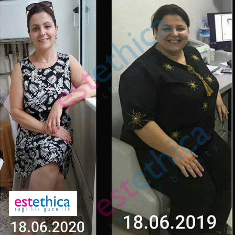 Gastric-Sleeve--1--W