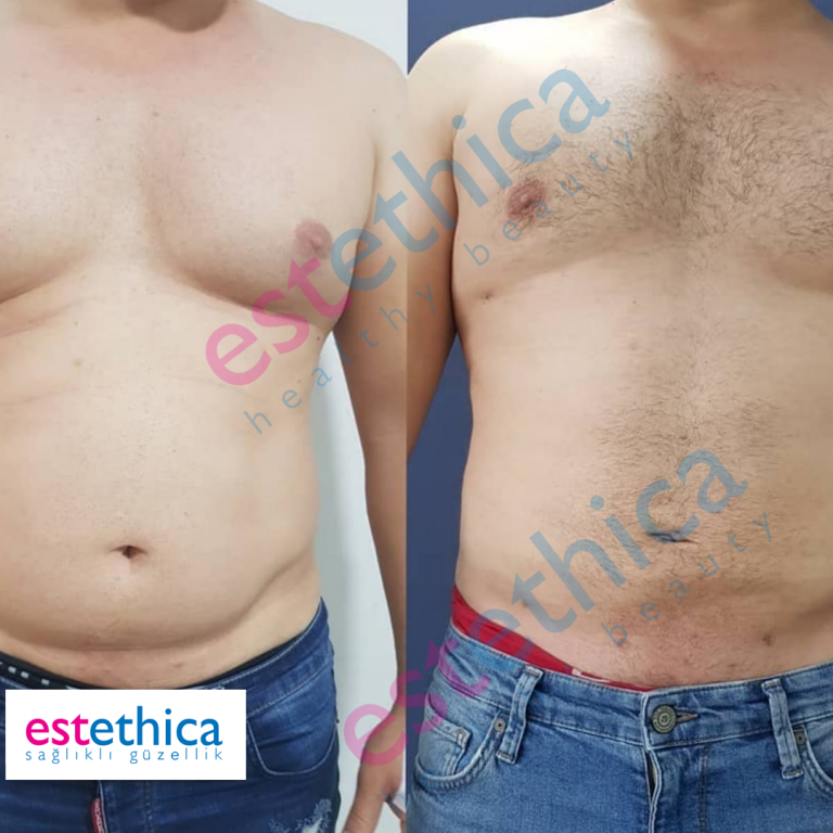 Lipo-3