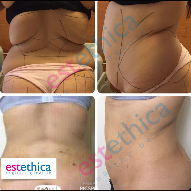 Lipo-4