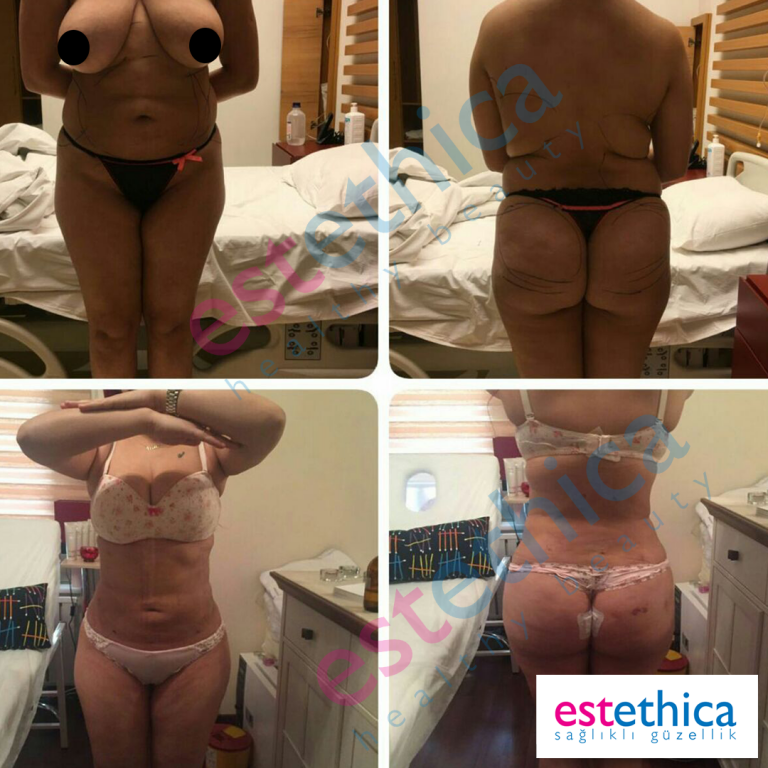 Lipo-5