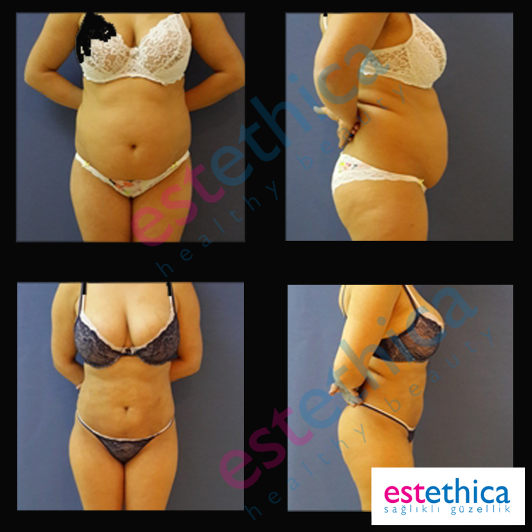 Lipo-6