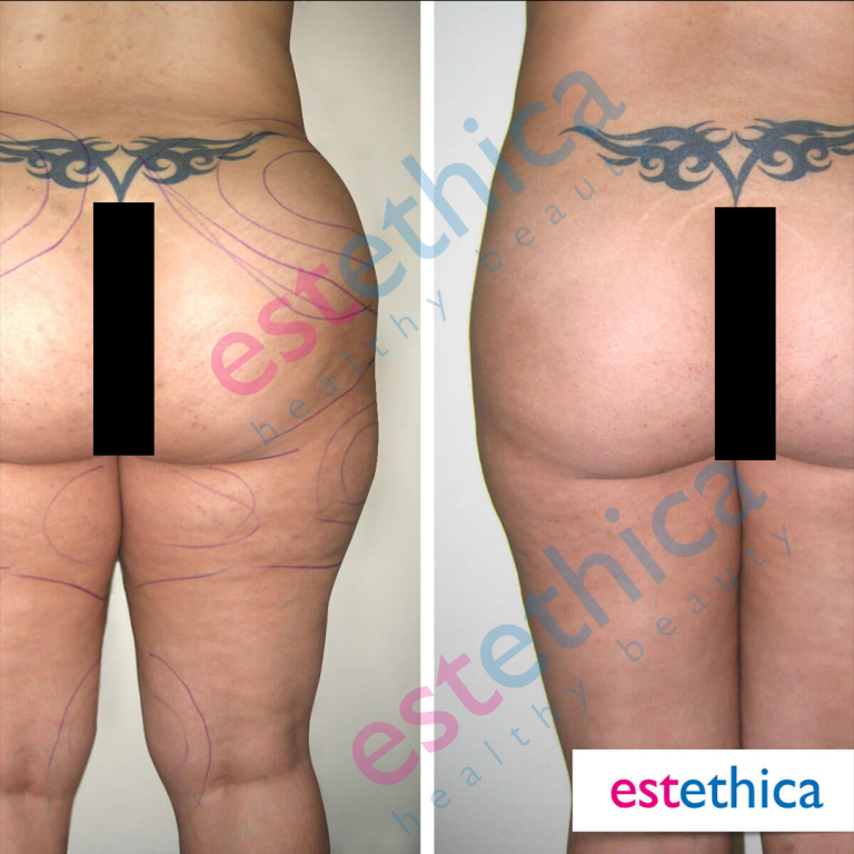 Slim-Lipo--1---W