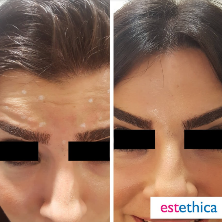 Botox-BA-1