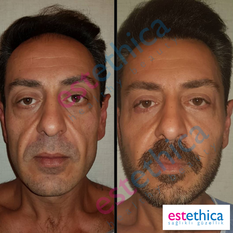 Face-Lif-Surgical--7