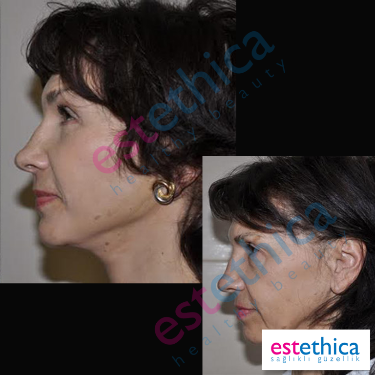 Face-Lift-W-4
