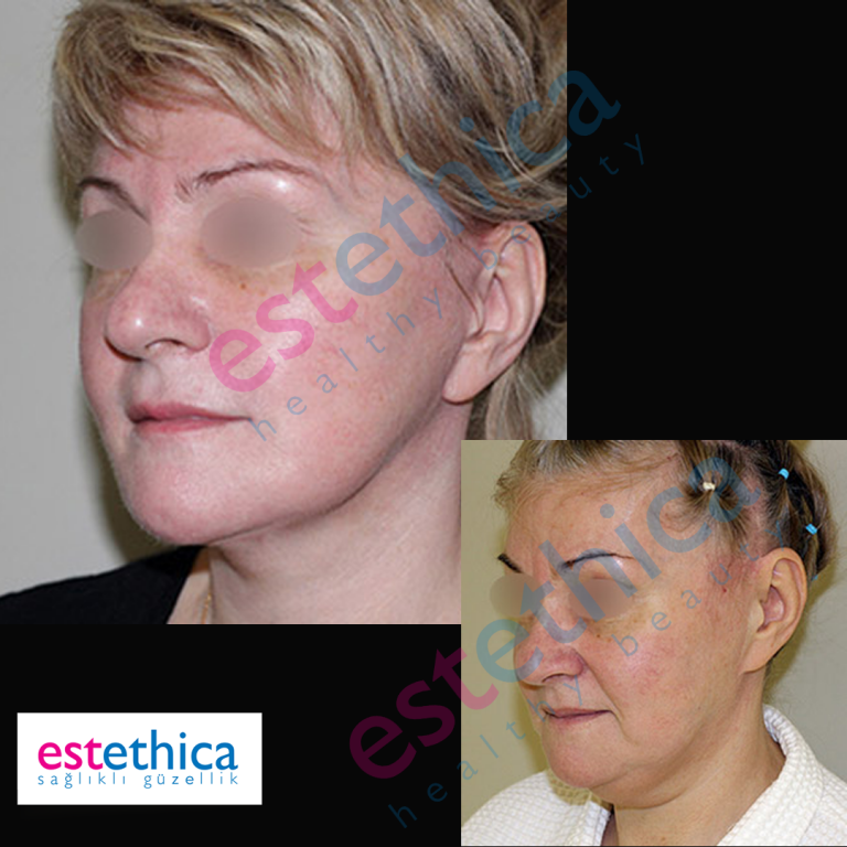 Face-Lift-W-5