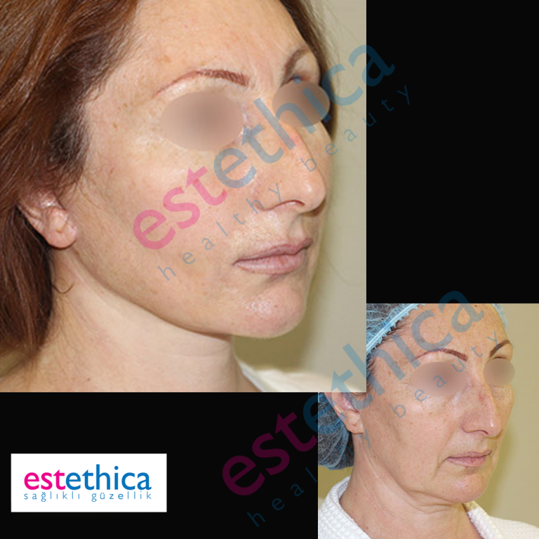 Face-Lift-W-6