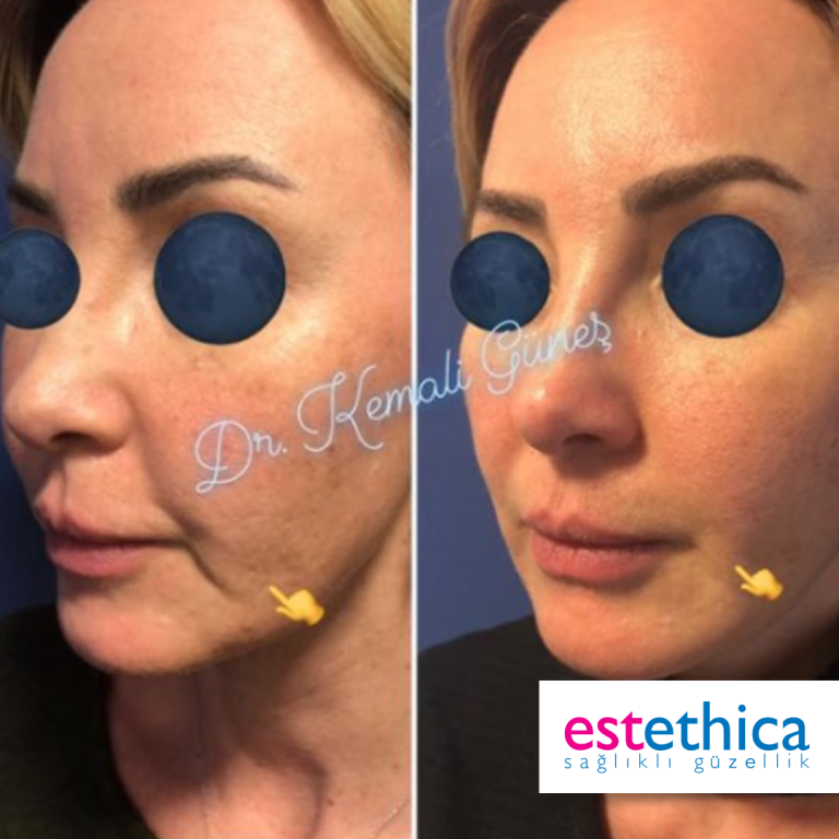 Facial-Filler-1