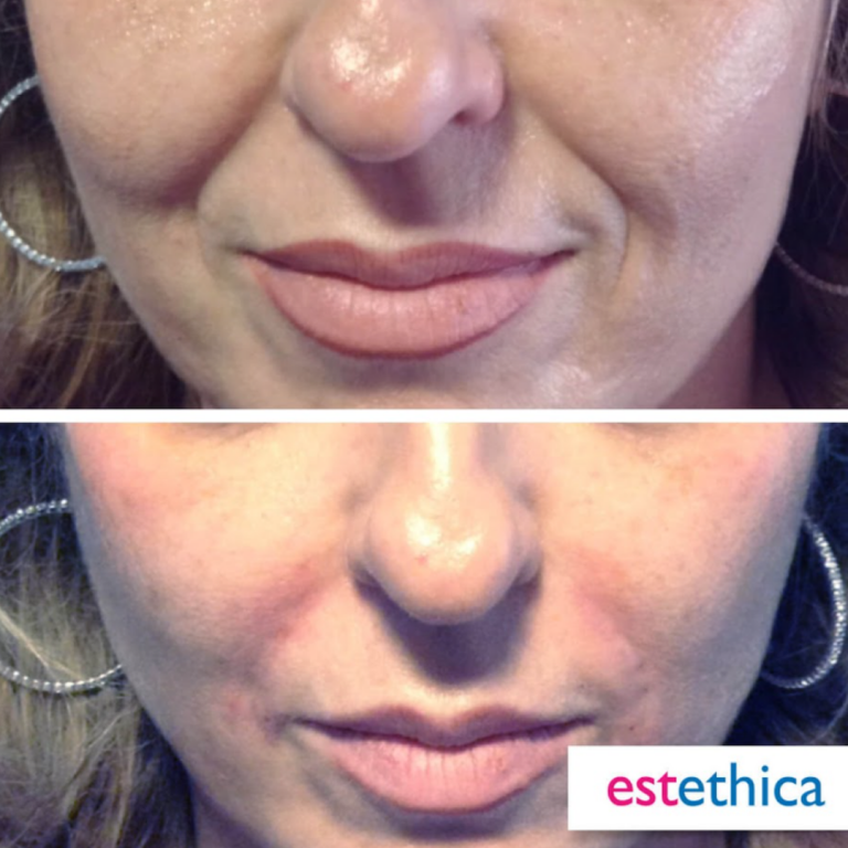 Facial-Filler-2