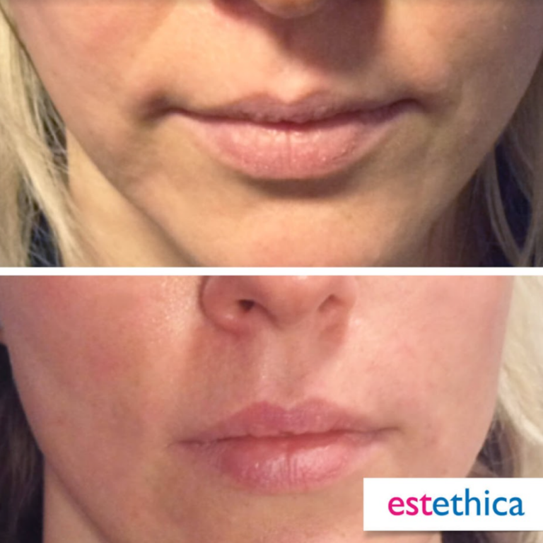 Facial-Filler-3