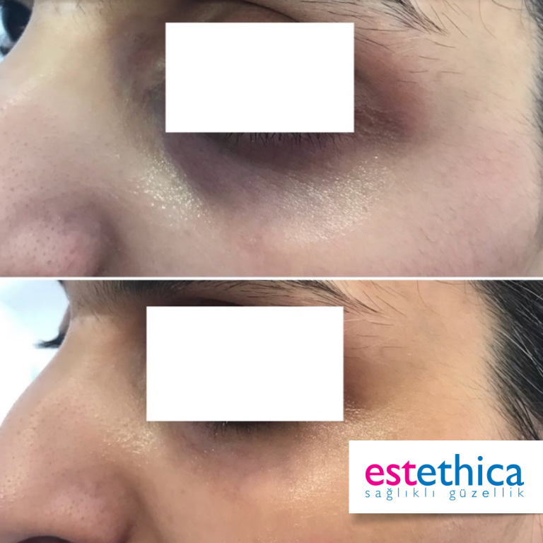 Facial-Filler-4