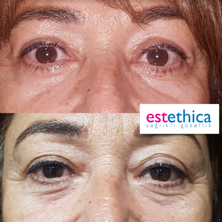Facial-Filler-5