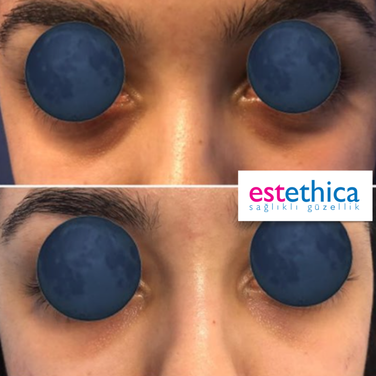 Facial-Filler-6