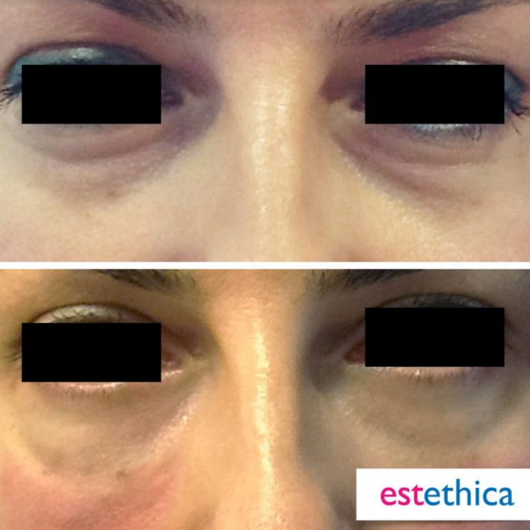 Facial-Filler-7