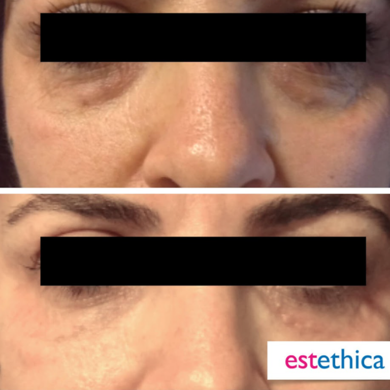 Facial-Filler-8