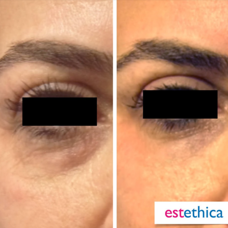 Facial-Filler-9