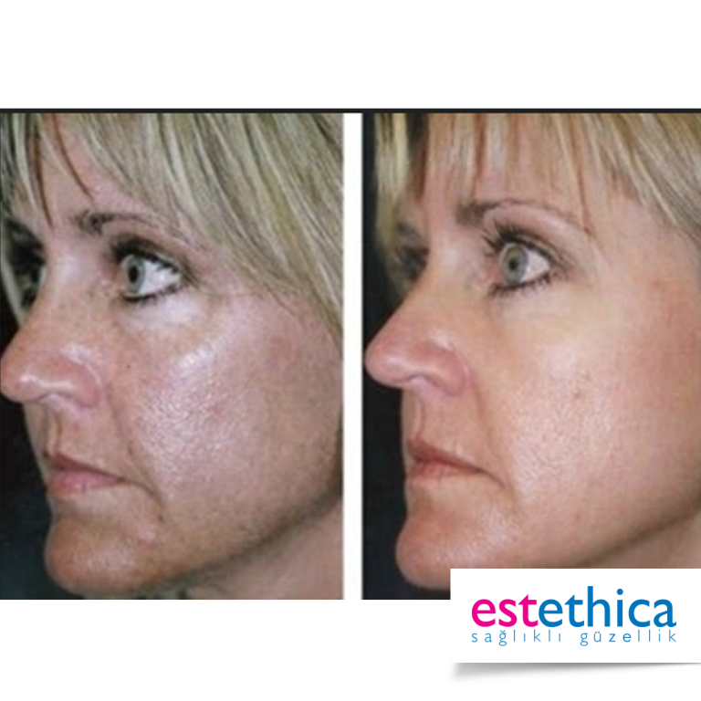 Fraksional-Laser-Before-After