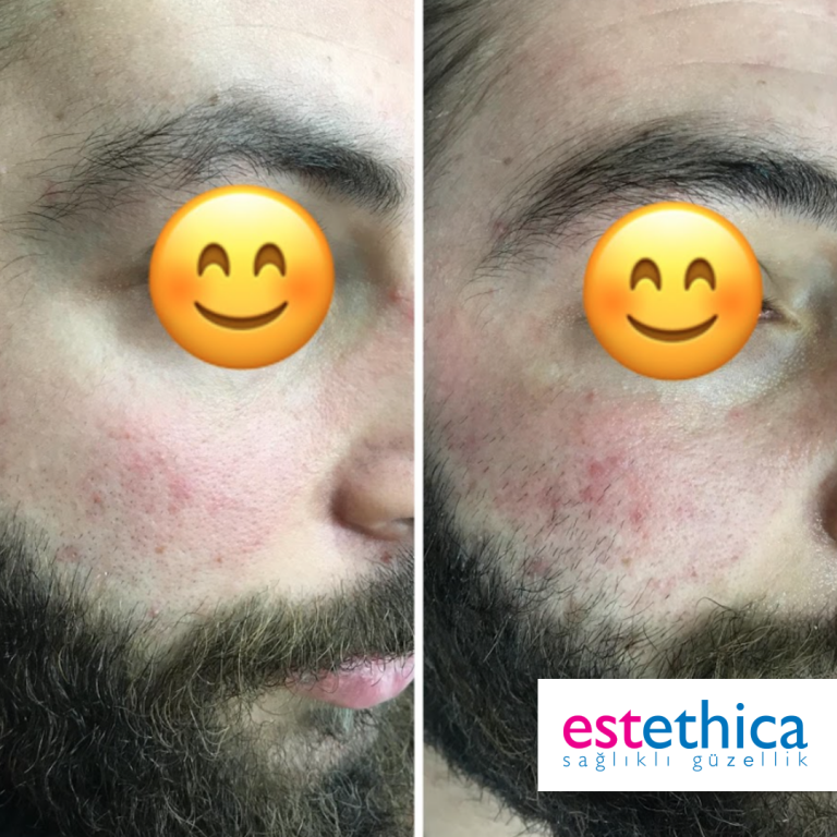 Laser-epilation-2-Before-After