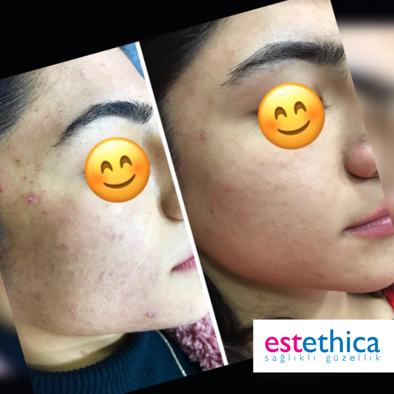 Laser-epilation-Before-After