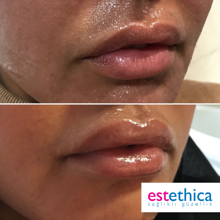Lip-filling-BA-1