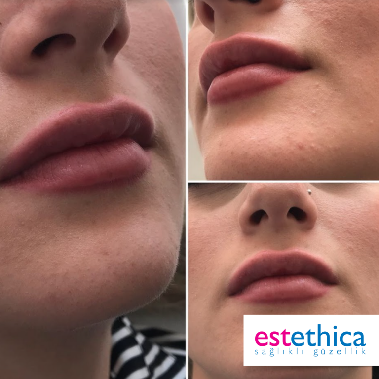Lip-filling-BA-2