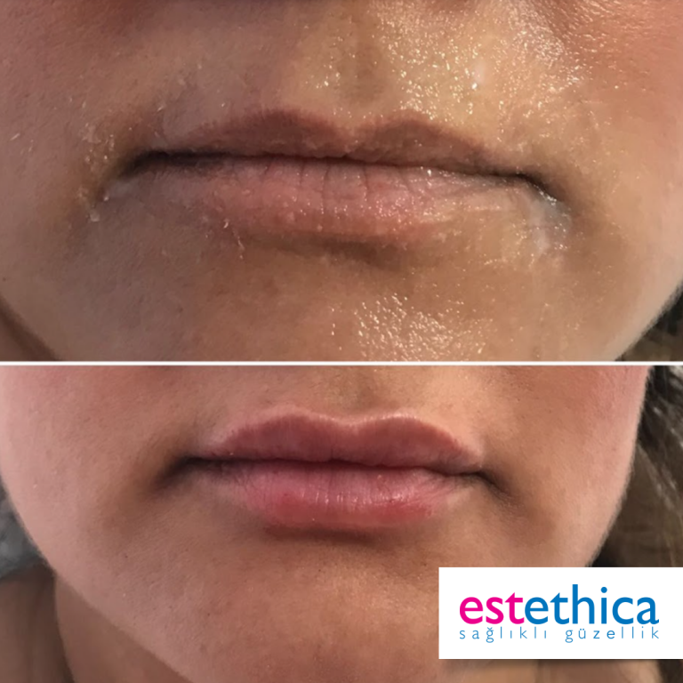 Lip-filling-BA-3