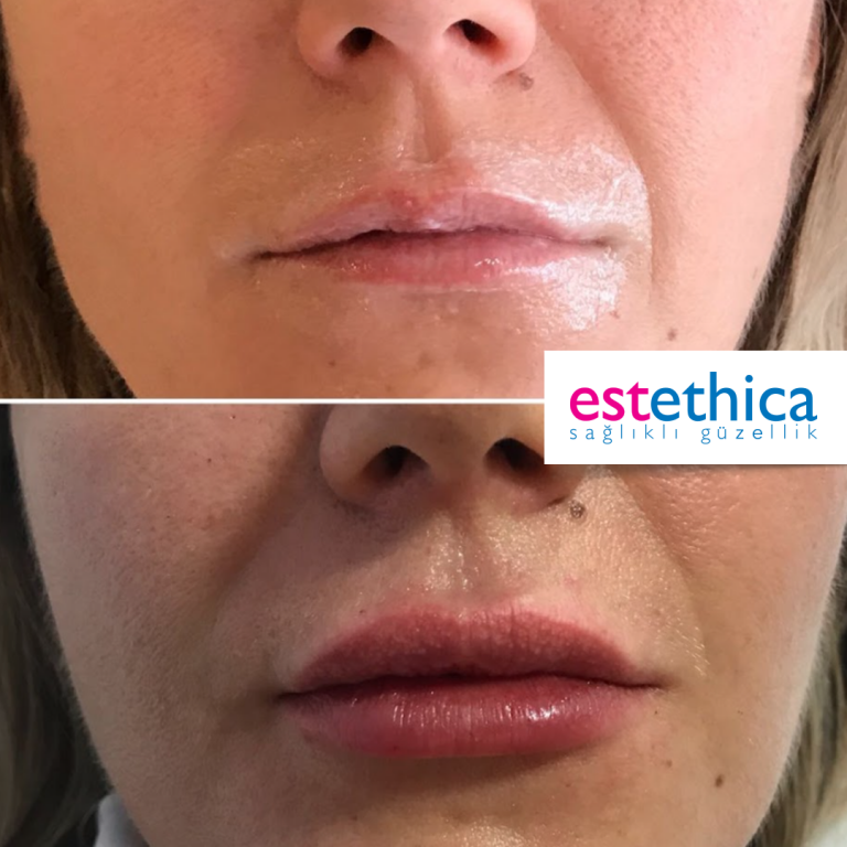 Lip-filling-BA-4