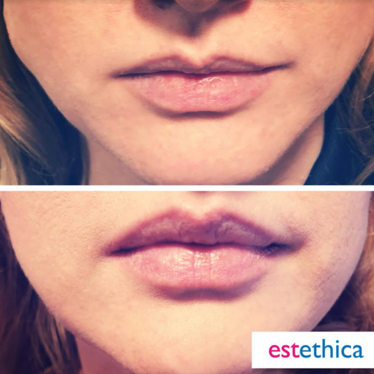 Lip-filling-BA-5
