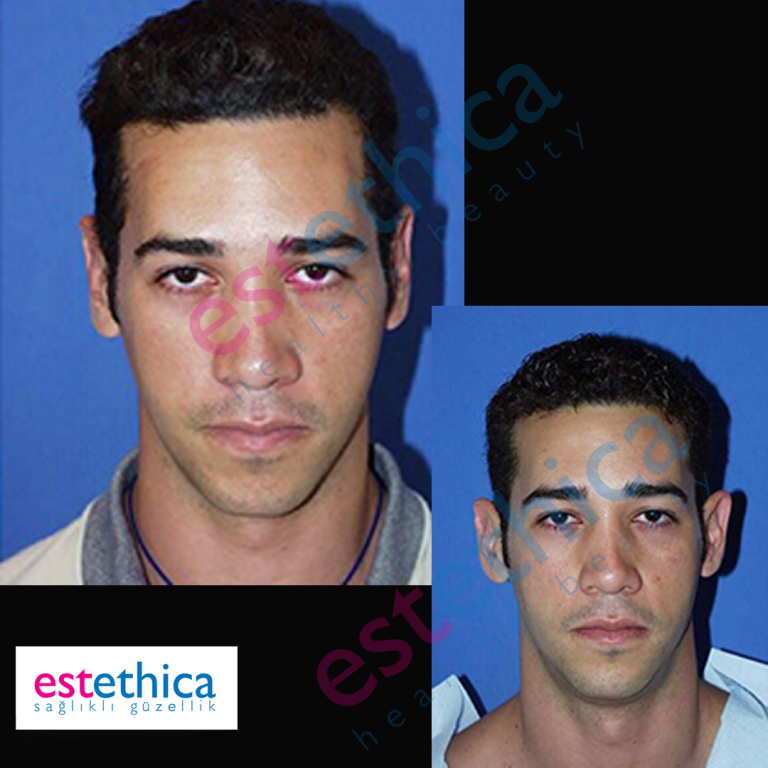 otoplasty-1