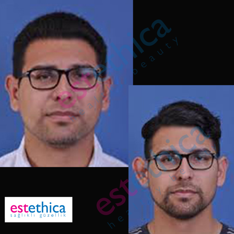 otoplasty-2