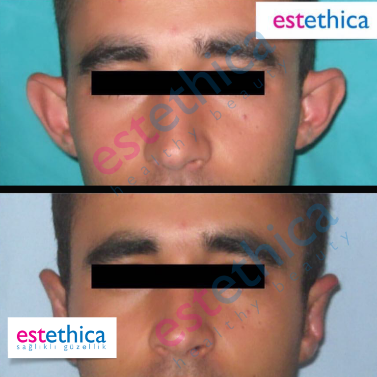 otoplasty-3