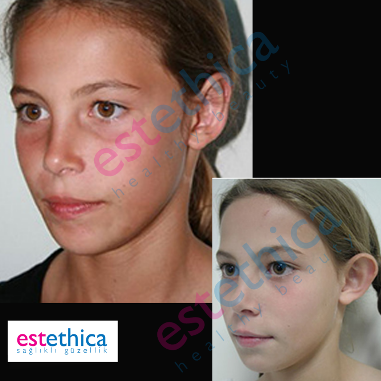 otoplasty-4