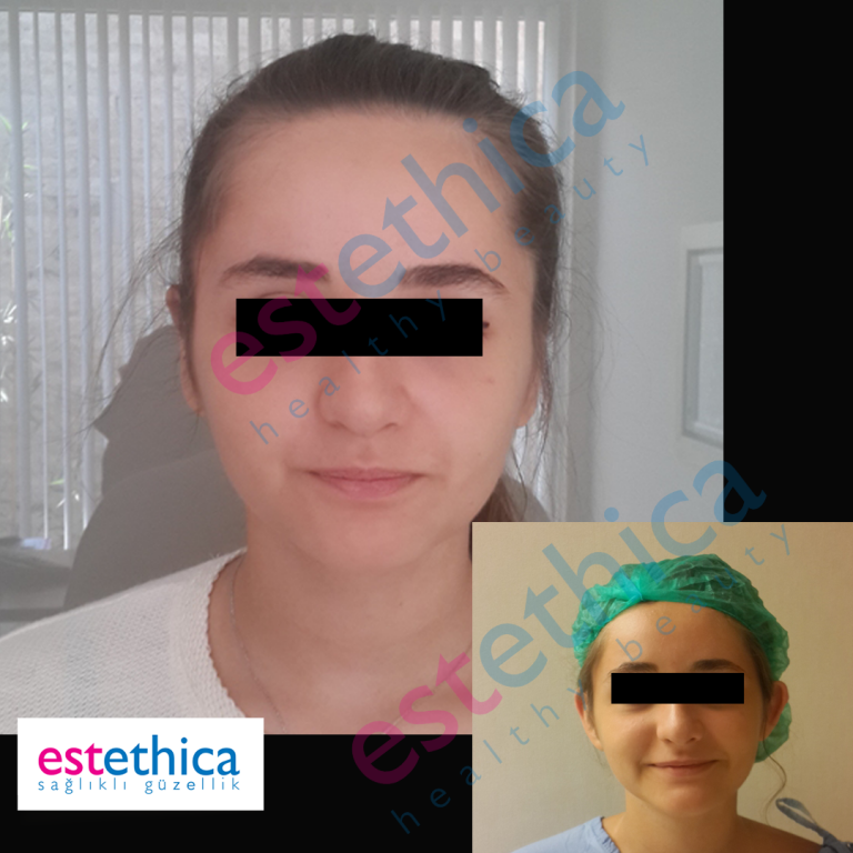 otoplasty-5